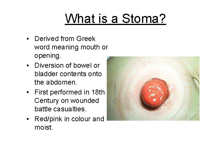 What is a Stoma? • Derived from Greek word meaning mouth or opening. •