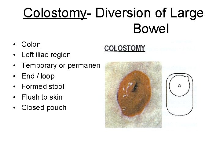 Colostomy- Diversion of Large Bowel • • Colon Left iliac region Temporary or permanent