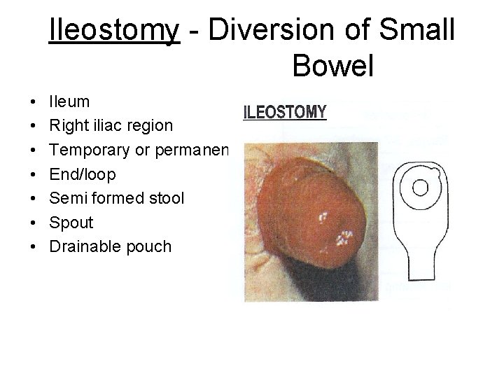 Ileostomy - Diversion of Small Bowel • • Ileum Right iliac region Temporary or