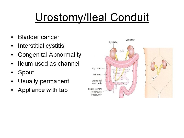 Urostomy/Ileal Conduit • • Bladder cancer Interstitial cystitis Congenital Abnormality Ileum used as channel