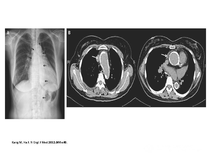 Porcelain Aorta Kang M, Ha J. N Engl J Med 2012; 366: e 40.