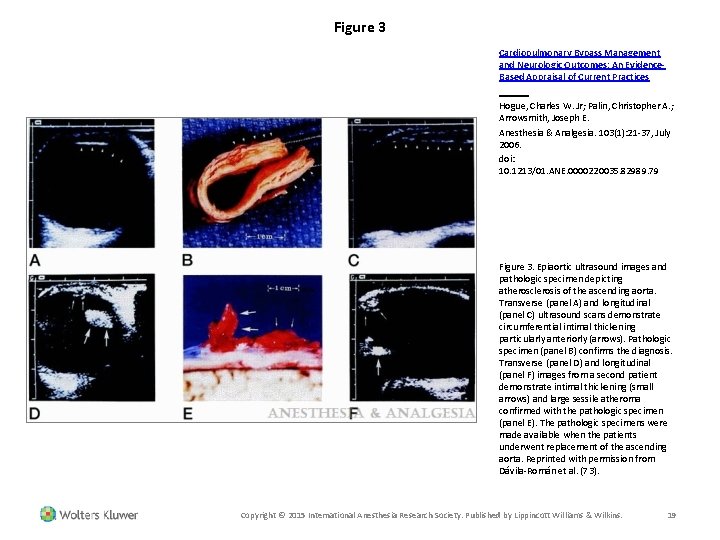 Figure 3 Cardiopulmonary Bypass Management and Neurologic Outcomes: An Evidence. Based Appraisal of Current