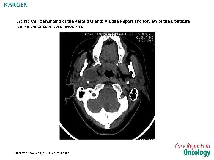 Acinic Cell Carcinoma of the Parotid Gland: A Case Report and Review of the