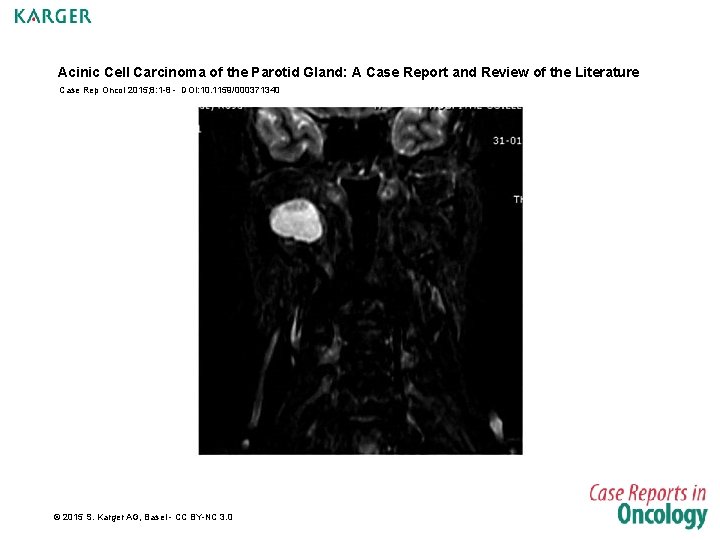 Acinic Cell Carcinoma of the Parotid Gland: A Case Report and Review of the