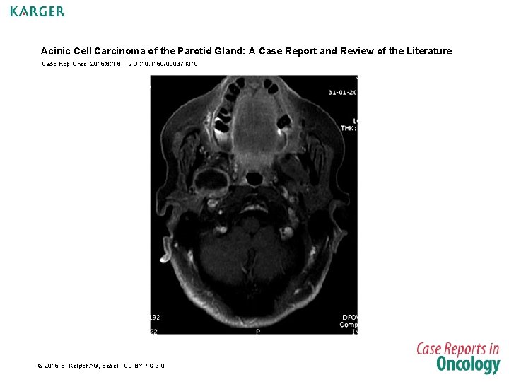 Acinic Cell Carcinoma of the Parotid Gland: A Case Report and Review of the