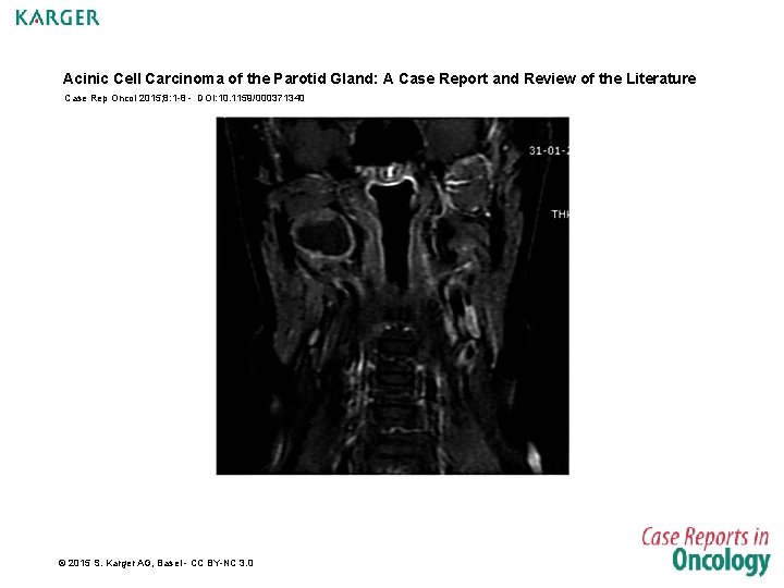 Acinic Cell Carcinoma of the Parotid Gland: A Case Report and Review of the