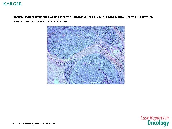 Acinic Cell Carcinoma of the Parotid Gland: A Case Report and Review of the