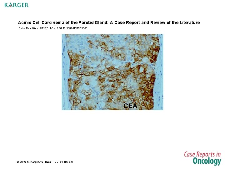 Acinic Cell Carcinoma of the Parotid Gland: A Case Report and Review of the