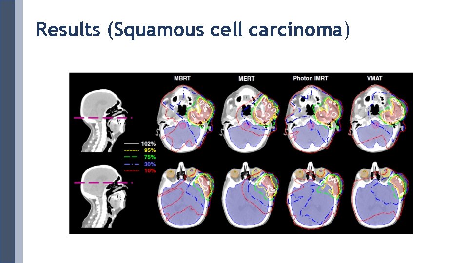 Results (Squamous cell carcinoma) 