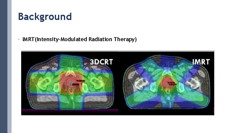 Background • IMRT(Intensity-Modulated Radiation Therapy) 