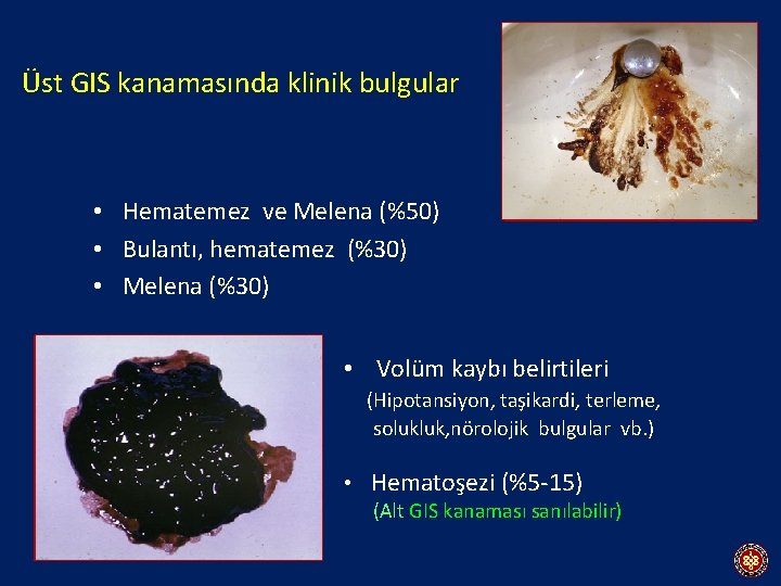 Üst GIS kanamasında klinik bulgular • Hematemez ve Melena (%50) • Bulantı, hematemez (%30)