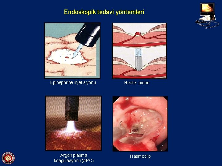 Endoskopik tedavi yöntemleri Epinephrine injeksiyonu Argon plasma koagülasyonu (APC) Heater probe Haemoclip 