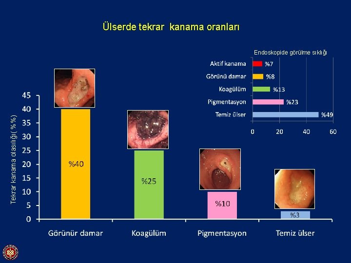 Ülserde tekrar kanama oranları Tekrar kanama olasılığı( %%) Endoskopide görülme sıklığı 