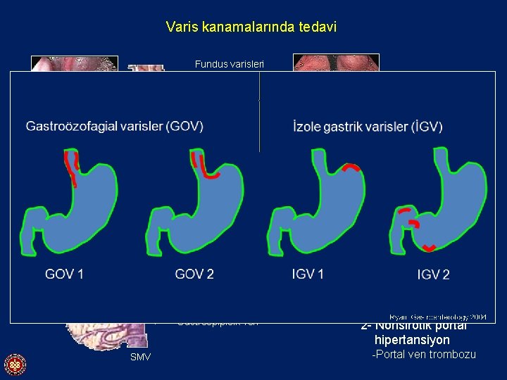 Varis kanamalarında tedavi Fundus varisleri Özofagus varisleri Kısa gastrik venler Coronar ven Vena Porta