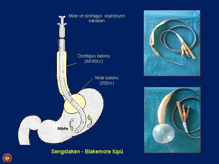 Mide ve özofagus aspirasyon kanalları Özofagusbalonu Özofagus (60 -80 cc) Mide balonu (200 cc)