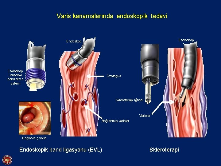 Varis kanamalarında endoskopik tedavi Endoskop ucundaki band atma sistemi Özofagus Skleroterapi iğnesi Varisler Bağlanmış