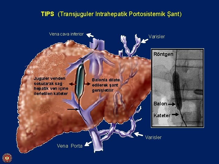 TIPS (Transjuguler Intrahepatik Portosistemik Şant) Vena cava inferior Varisler Röntgen Juguler venden sokularak sağ