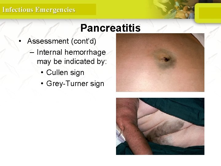 Infectious Emergencies © Wellcome Trust/Custom Medical Stock Photo • Assessment (cont’d) – Internal hemorrhage