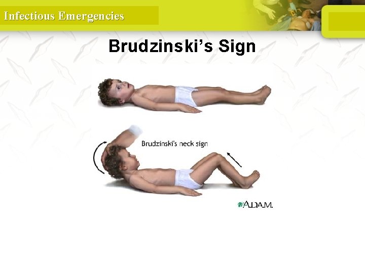 Infectious Emergencies Brudzinski’s Sign 