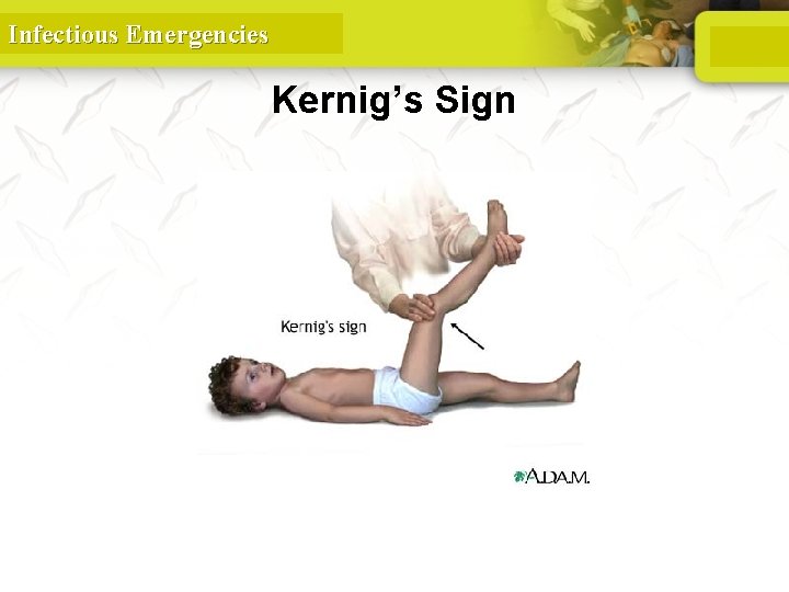 Infectious Emergencies Kernig’s Sign 