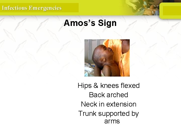 Infectious Emergencies Amos’s Sign Hips & knees flexed Back arched Neck in extension Trunk