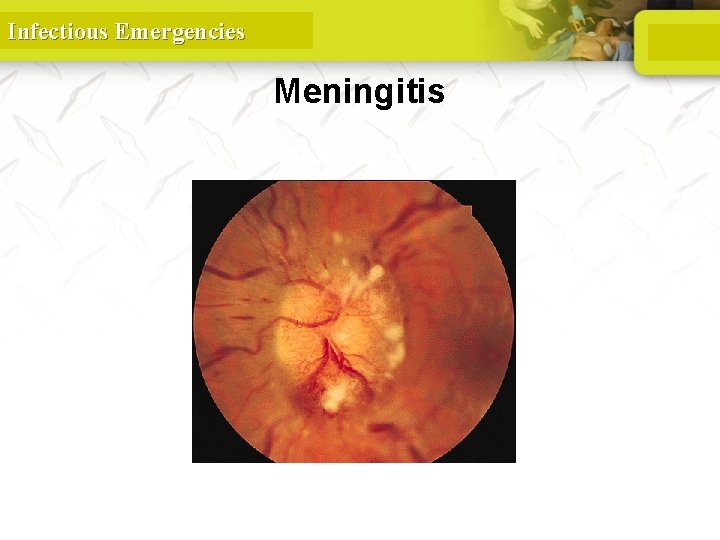 Infectious Emergencies Meningitis Papilledema 