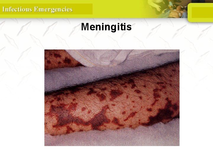 Infectious Emergencies Meningitis 
