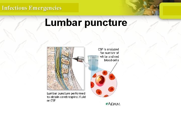 Infectious Emergencies Lumbar puncture 