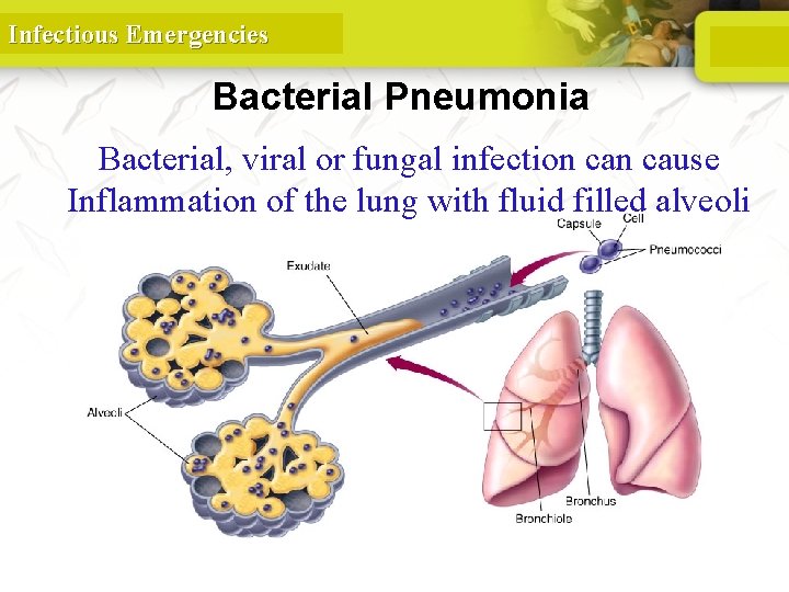 Infectious Emergencies Bacterial Pneumonia Bacterial, viral or fungal infection cause Inflammation of the lung