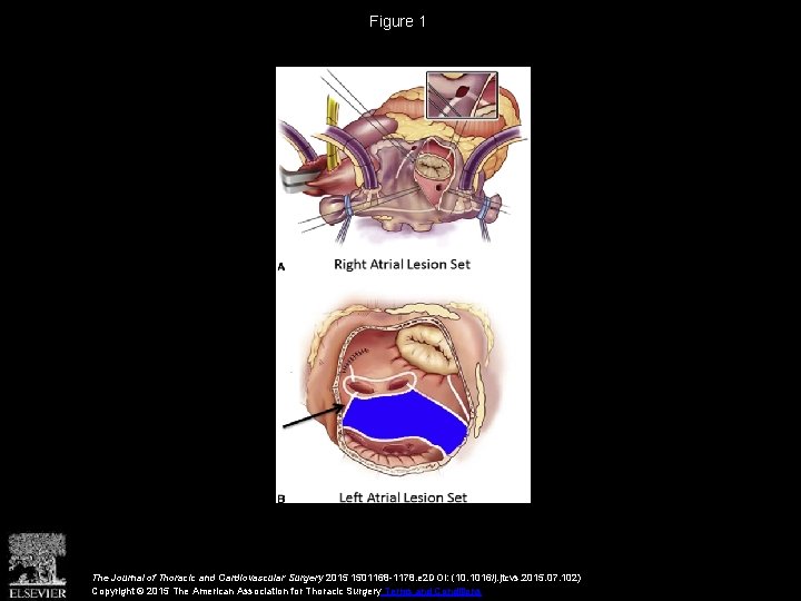 Figure 1 The Journal of Thoracic and Cardiovascular Surgery 2015 1501168 -1178. e 2