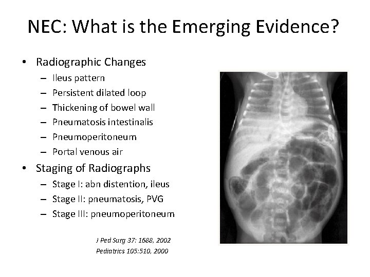 NEC: What is the Emerging Evidence? • Radiographic Changes – – – Ileus pattern