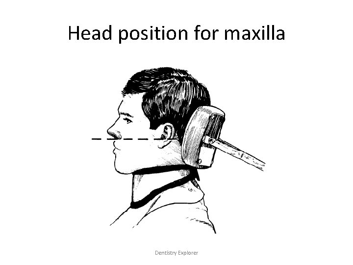 Head position for maxilla Dentistry Explorer Head position for maxilla Dentistry Explorer