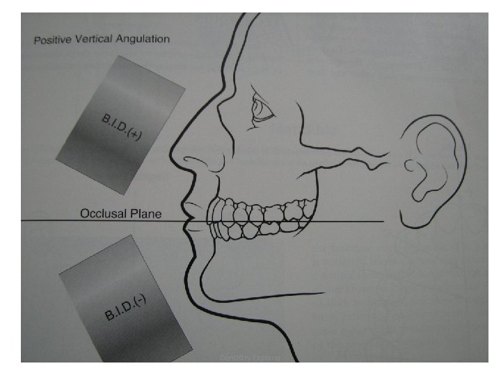 X-ray beam angulation Dentistry Explorer 