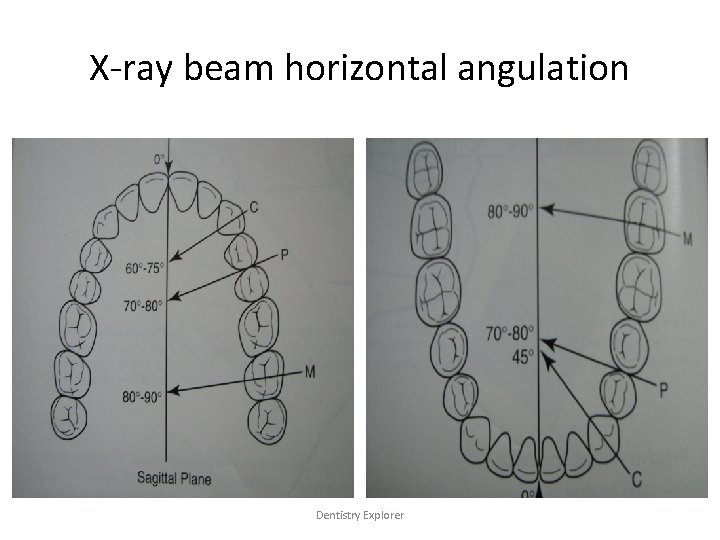 X-ray beam horizontal angulation Dentistry Explorer 