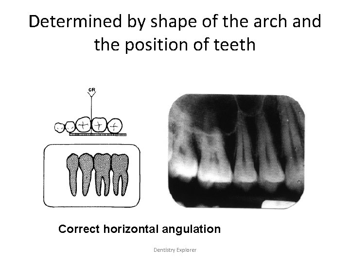 Determined by shape of the arch and the position of teeth Correct horizontal angulation