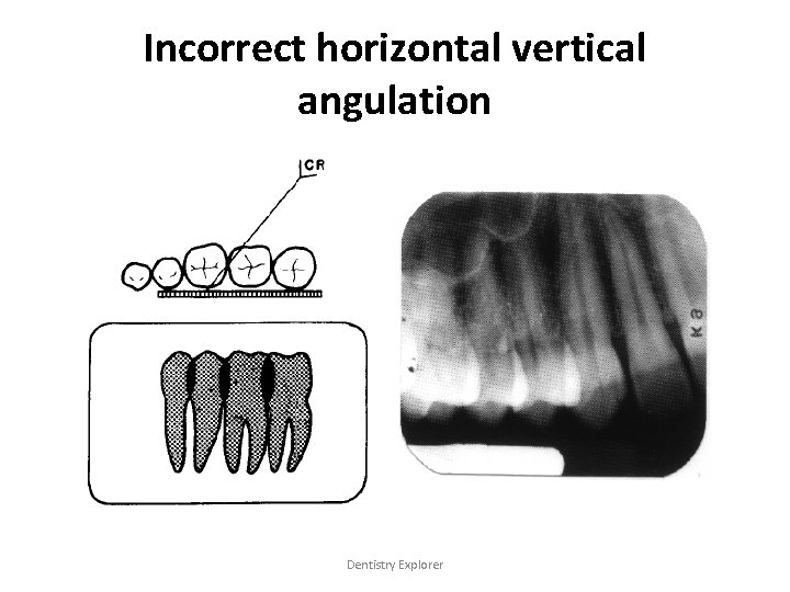 Incorrect horizontal vertical angulation Dentistry Explorer 