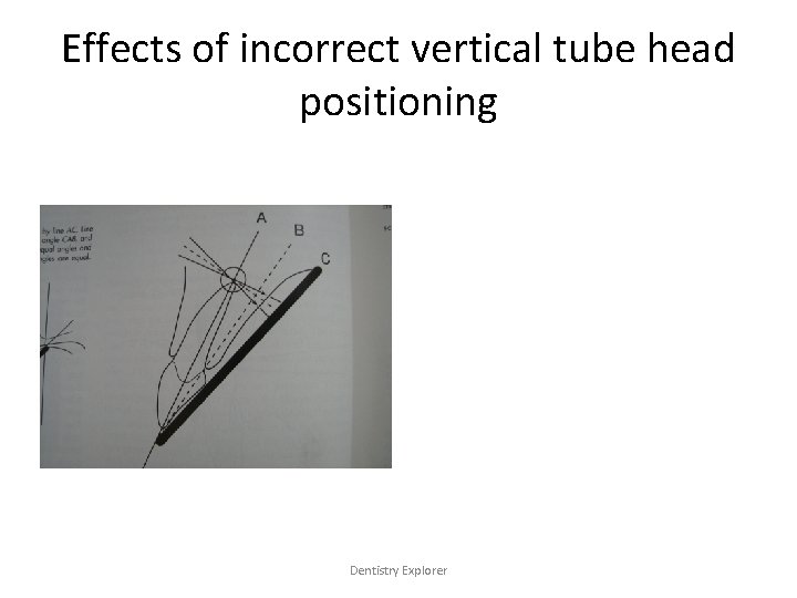 Effects of incorrect vertical tube head positioning Dentistry Explorer 