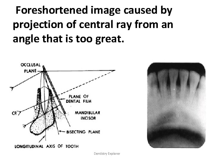 Foreshortened image caused by projection of central ray from an angle that is too