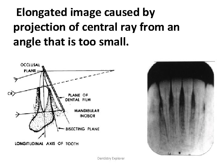 Elongated image caused by projection of central ray from an angle that is too