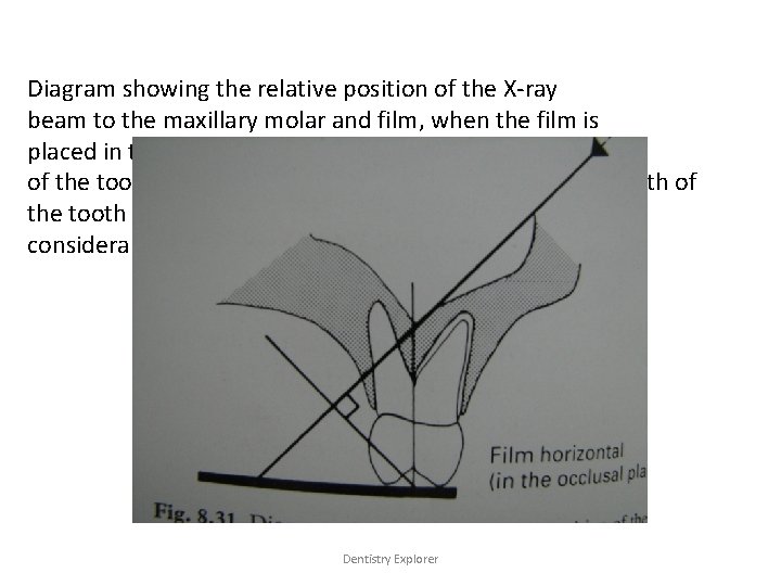 Diagram showing the relative position of the X-ray beam to the maxillary molar and