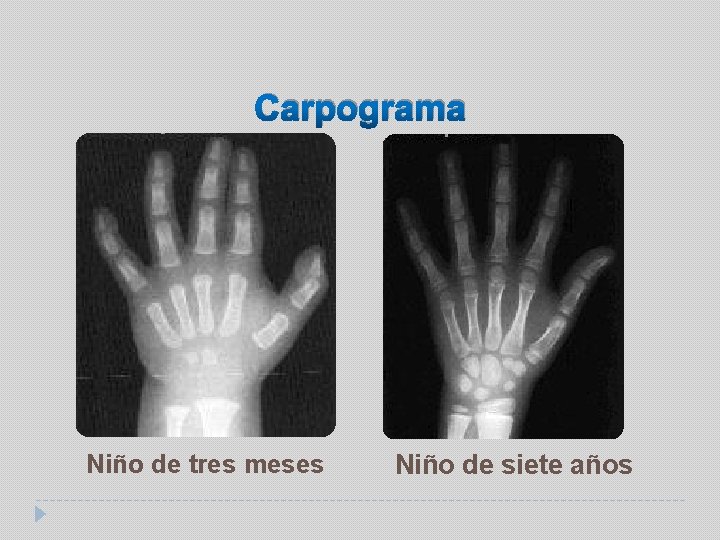 Carpograma Niño de tres meses Niño de siete años 