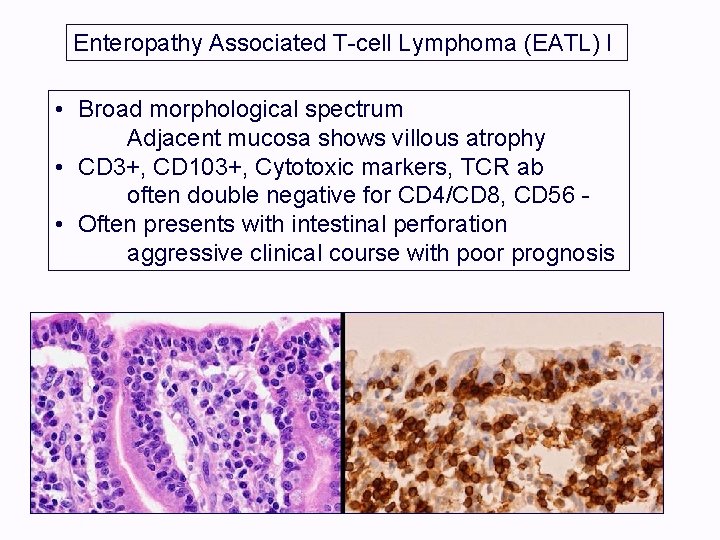 Enteropathy Associated T-cell Lymphoma (EATL) I • Broad morphological spectrum Adjacent mucosa shows villous