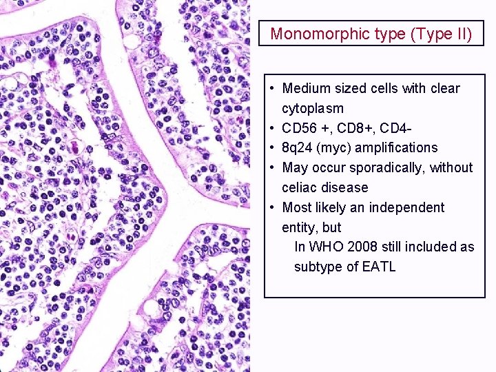 Monomorphic type (Type II) • Medium sized cells with clear cytoplasm • CD 56
