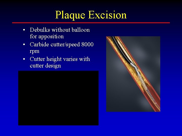 Plaque Excision • Debulks without balloon for apposition • Carbide cutter/speed 8000 rpm •