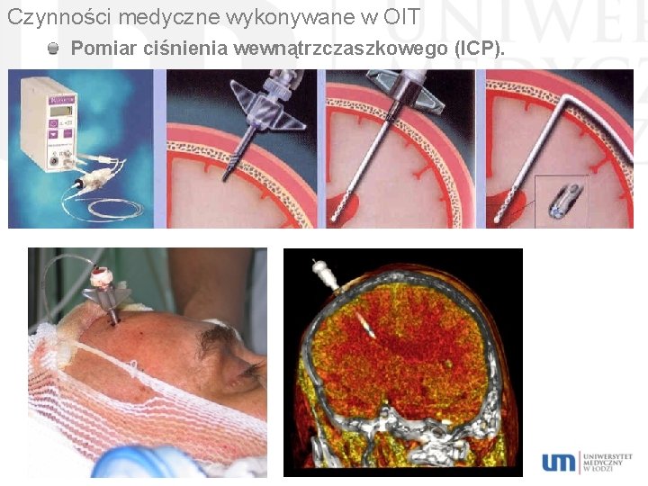 Czynności medyczne wykonywane w OIT Pomiar ciśnienia wewnątrzczaszkowego (ICP). 