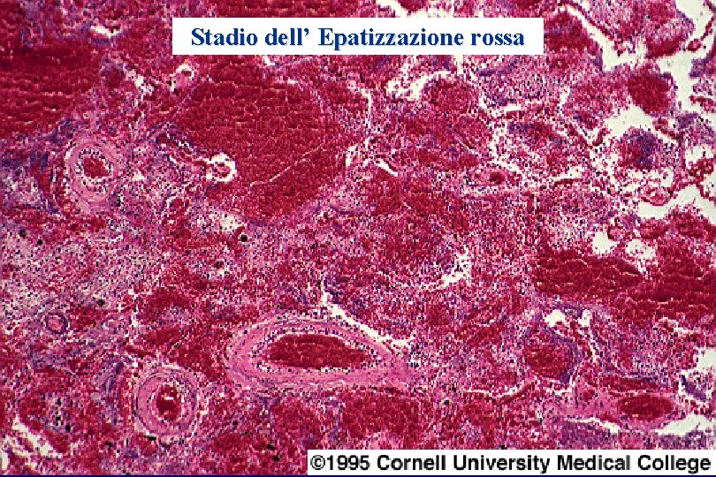 Stadio dell’ Epatizzazione rossa 