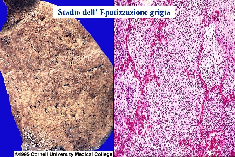 Stadio dell’ Epatizzazione grigia 