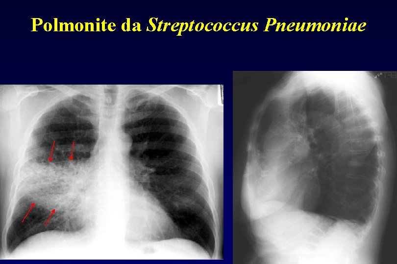 Polmonite da Streptococcus Pneumoniae 