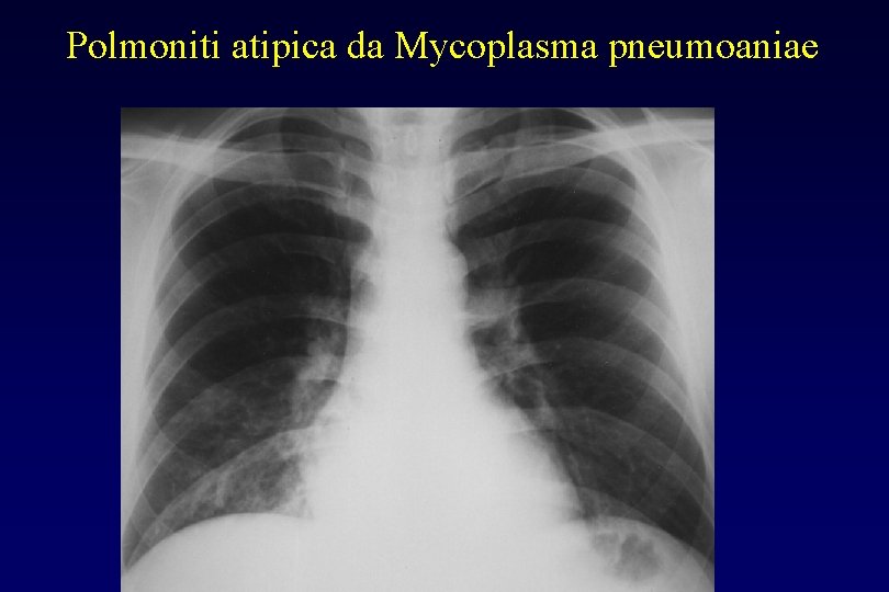 Polmoniti atipica da Mycoplasma pneumoaniae 