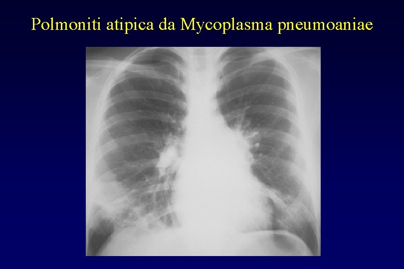 Polmoniti atipica da Mycoplasma pneumoaniae 